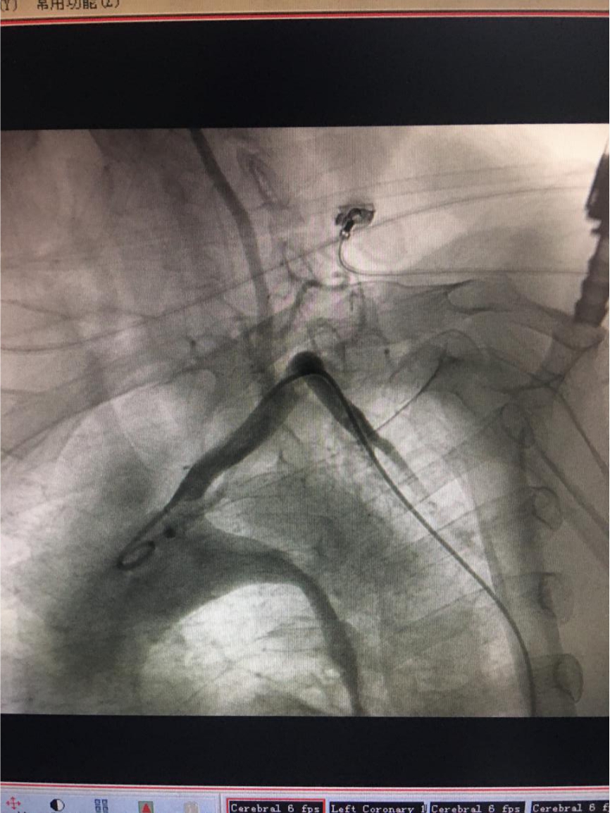 2、主动脉DSA检查：主动脉弓-降主动脉处见破裂口。.jpg