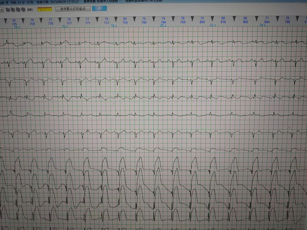 患者发病后第一份心电图提示急性广泛前壁心肌梗死.png