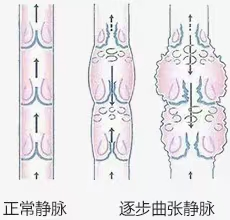 4正常静脉和逐步曲张静脉.png 4正常静脉和逐步曲张静脉.png