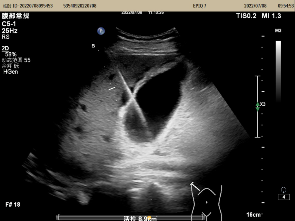 2胆囊穿刺置管引流术中.png