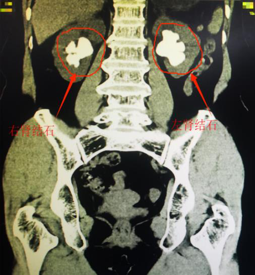 CT检查提示陈阿姨双肾被结石占满1.png