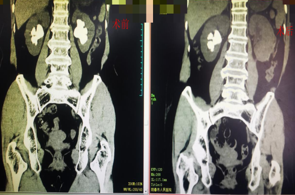 术前术后对比图.png