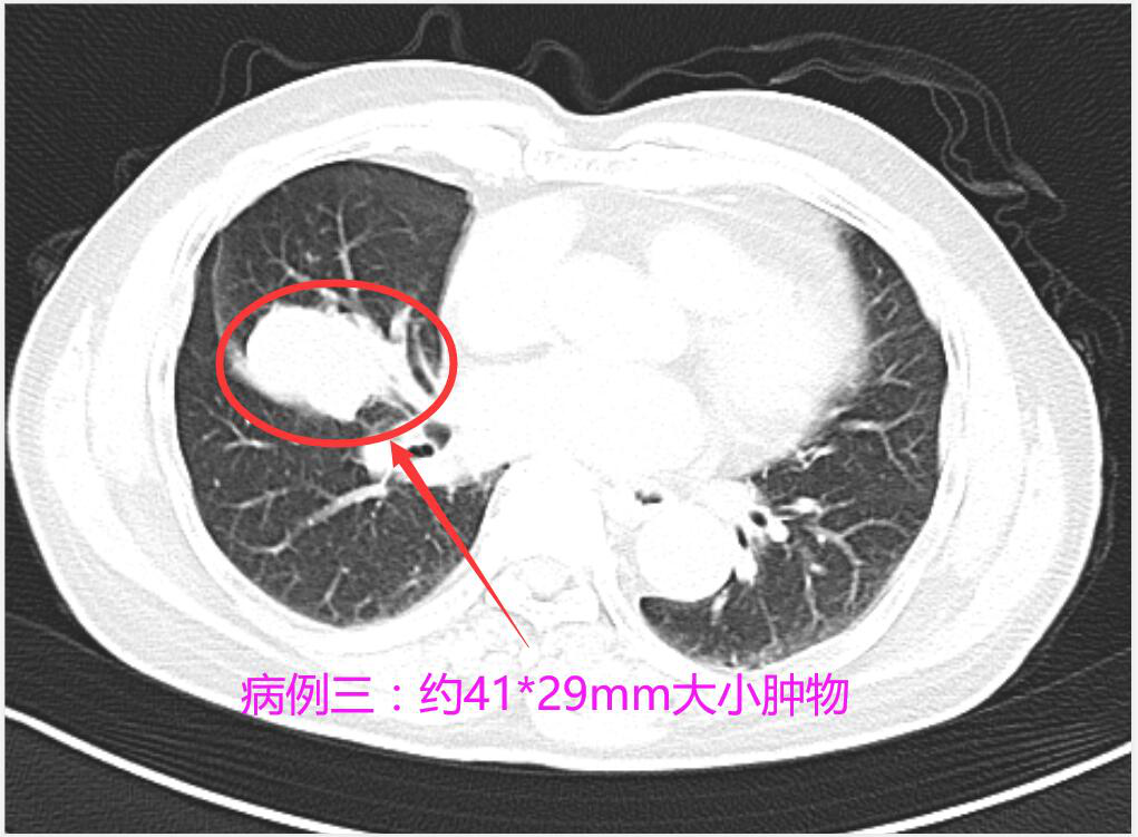 阳春市人民医院:规范检查,早期处理肺结节是治疗肺癌的关键,莫让肺