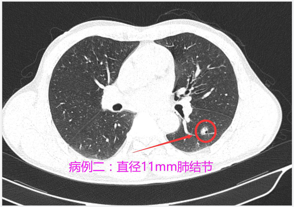 肺门ct图片