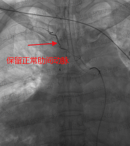 保留正常肋间动脉供血.png 保留正常肋间动脉供血.png