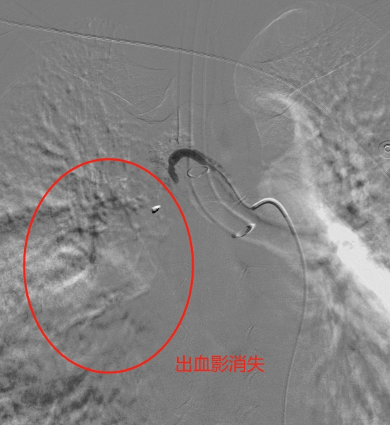 再造影见右肺出血影消失.png 再造影见右肺出血影消失.png