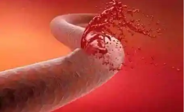 支气管动脉破裂出血示意图.png 支气管动脉破裂出血示意图.png